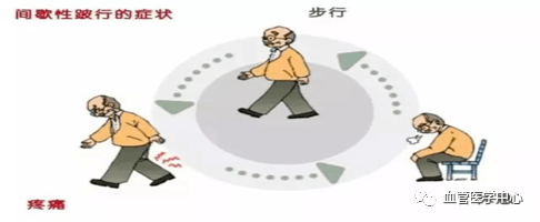 患肢的侧支循环,改善下肢的血液供血不足,应坚持定时做buerger运动