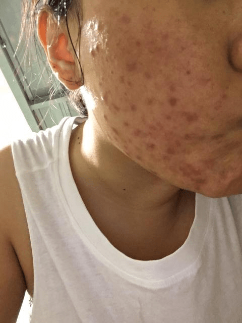 3天快速淡化红痘印 c8dfdd551b5d41ed9b26b31cb1efe740.png