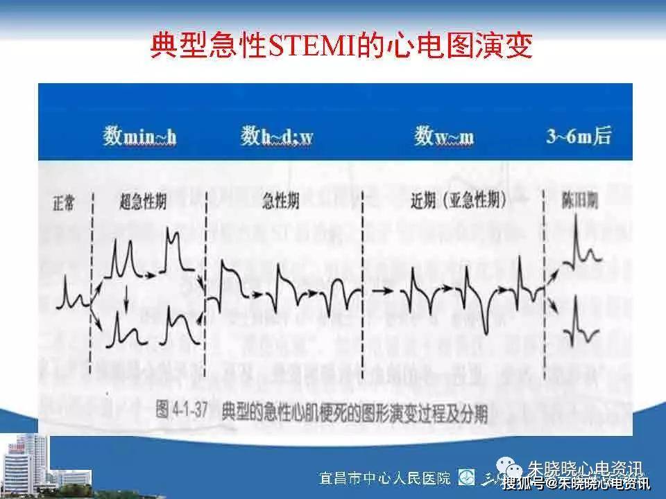 急性冠脉综合征心电图与临床ppt