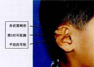 耳轮,即是弯折的皮肤边缘,耳廓周围的软骨.