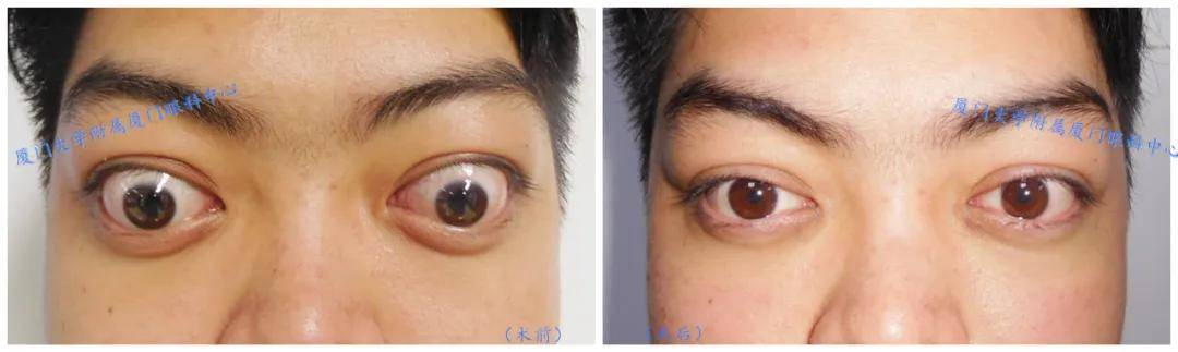 手术十分顺利,术后小廖的双眼突出明显好转,眼球恢复到能够向各个