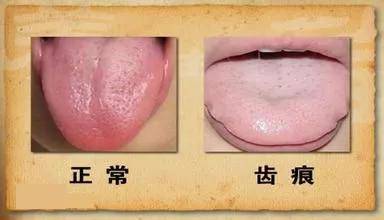 且多数无舌苔,中医称"裂纹舌",如果没有不适症状者亦属于生理性,不