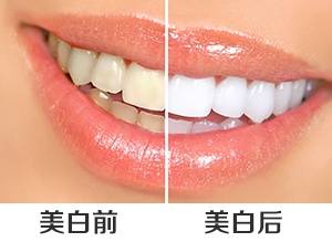 牙齿美白医院排名_医院冷光美白牙齿图片(3)