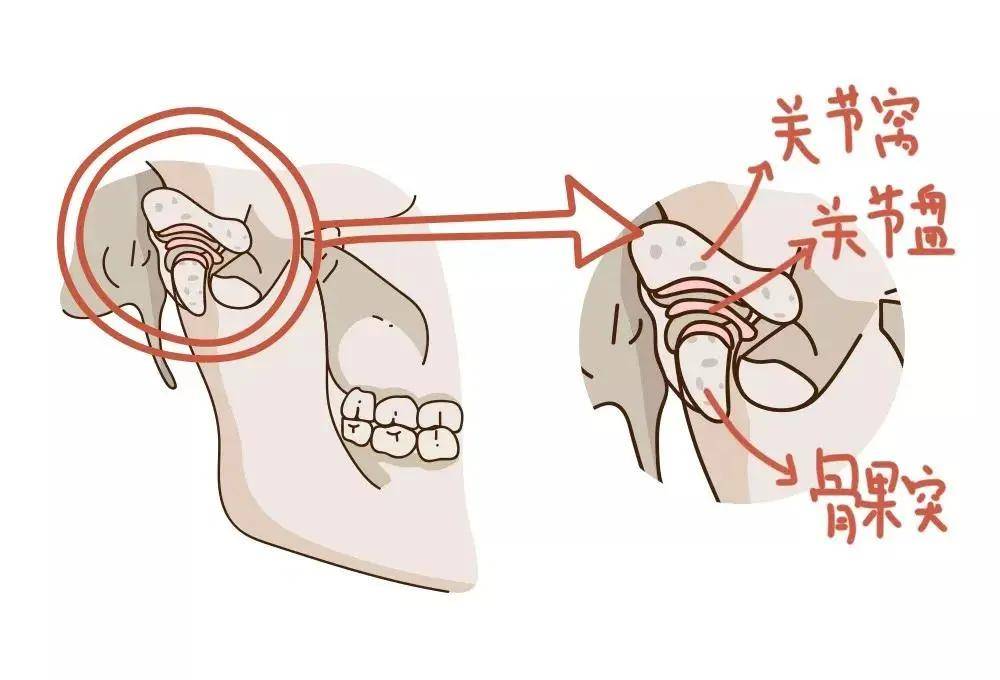 如果早期不及时治疗,病情将逐级发展,关节软骨和关节盘磨损不断加重