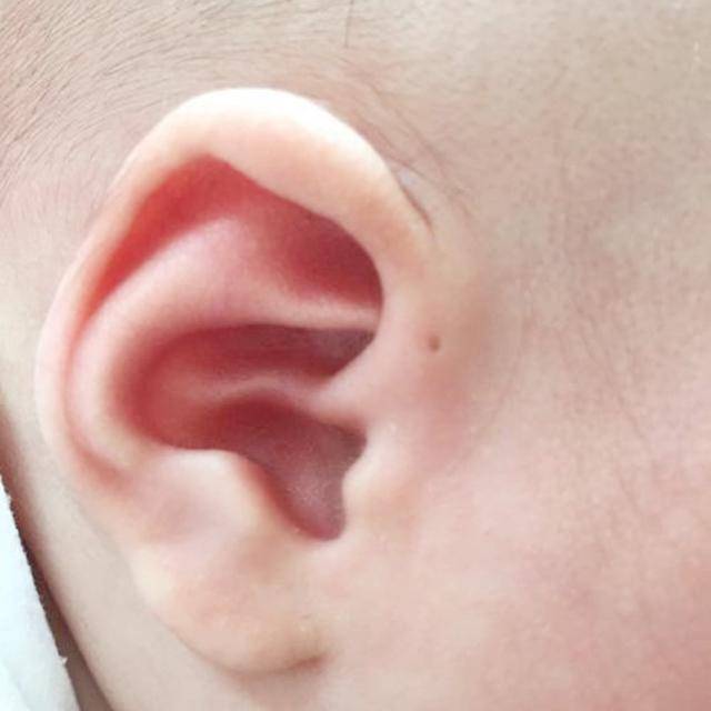为何有些孩子耳朵上会有“小孔”，医生没有直接讲，家长也要知道