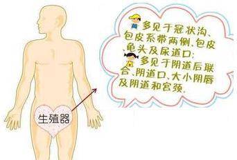 尖锐湿疣医院排名