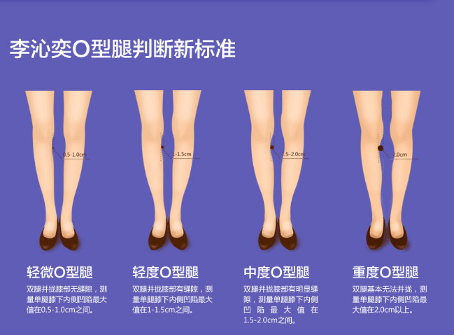 北京如何矫正o型腿?北京李沁奕腿部整形中心