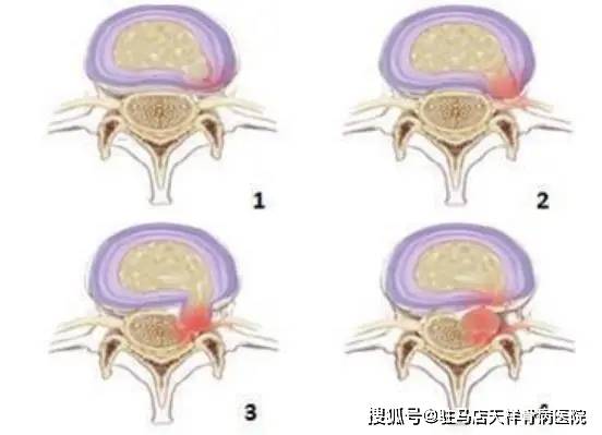 腰椎间盘突出脚痛怎么办