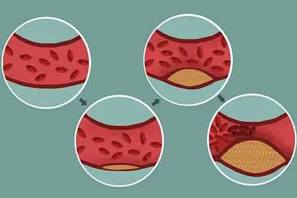 低密度胆固醇和高密度胆固醇什么意思 aff3f27ef539435eab14797fc5719da5.jpeg