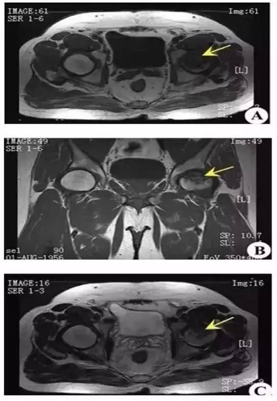 【干货】股骨头坏死的x,ct,mri的影像诊断!