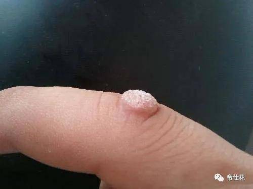 瘊子的病程与机体免疫有重要的关系，在相对健康的人群中，寻常疣可以长期不消退