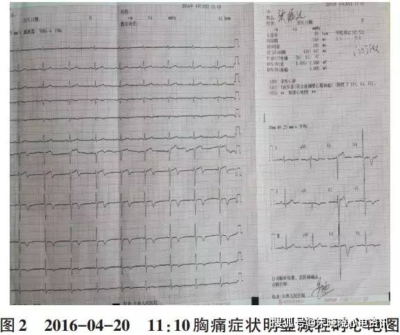 wellens综合征1例及其鉴别诊断