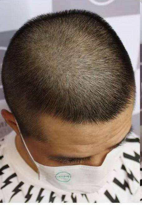 中年男人5级遗传性脱发,5个小时之后大变身