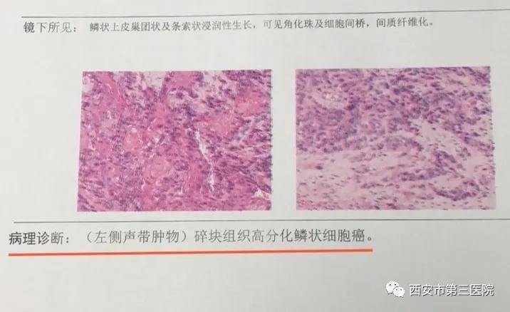 西安市第三医院耳鼻喉科成功为喉癌患者实施