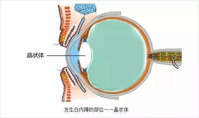 【白内障科普】白内障的早期症状,不同时期不同症状!