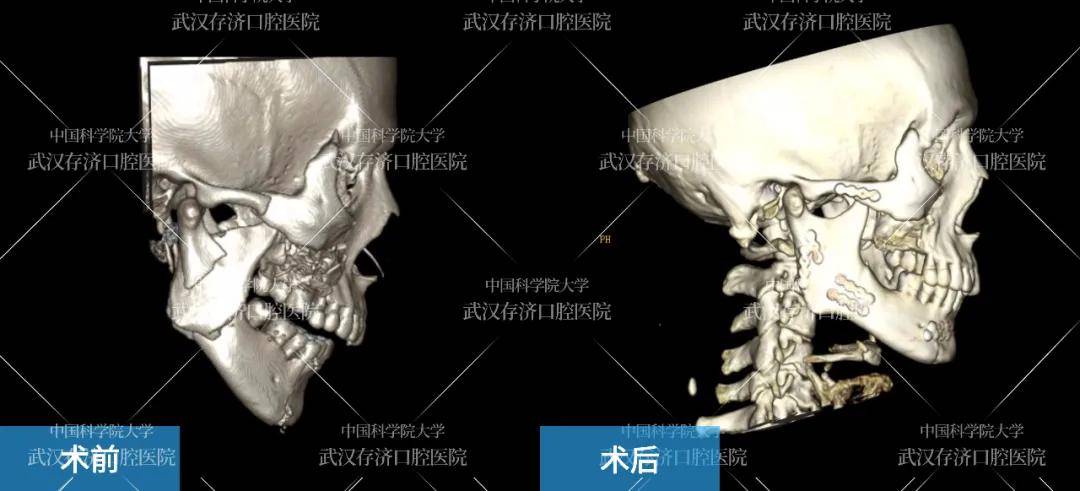 手术前后对比 侧面观 万一发生颌骨骨折,有什么后果?