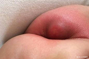 终身|只因妈妈的一个疏忽，要谨记！新生男婴吃了糖丸后落下终身残疾