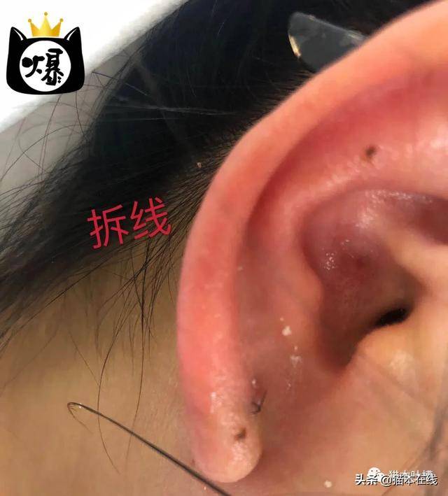 墨尔本cbd医美店打耳洞致消费者耳朵发炎只能靠做手术取出耳钉