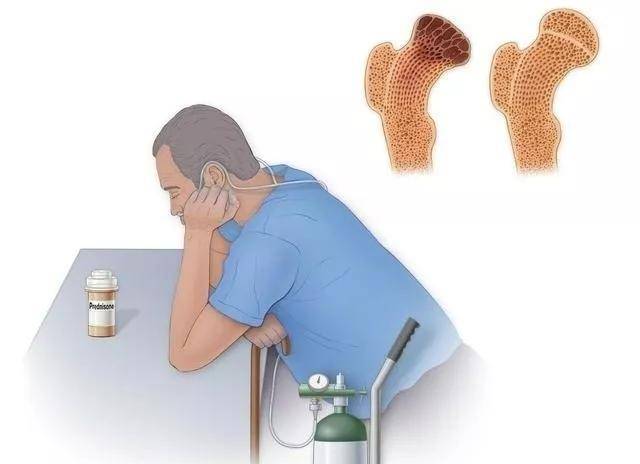 股骨头坏死老生常谈的康复必要条件