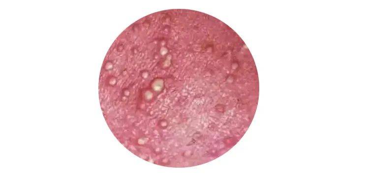 皮肤的皱褶处,例如脖子,腋窝和腹股沟,特征为红斑和针头大小的丘疱疹