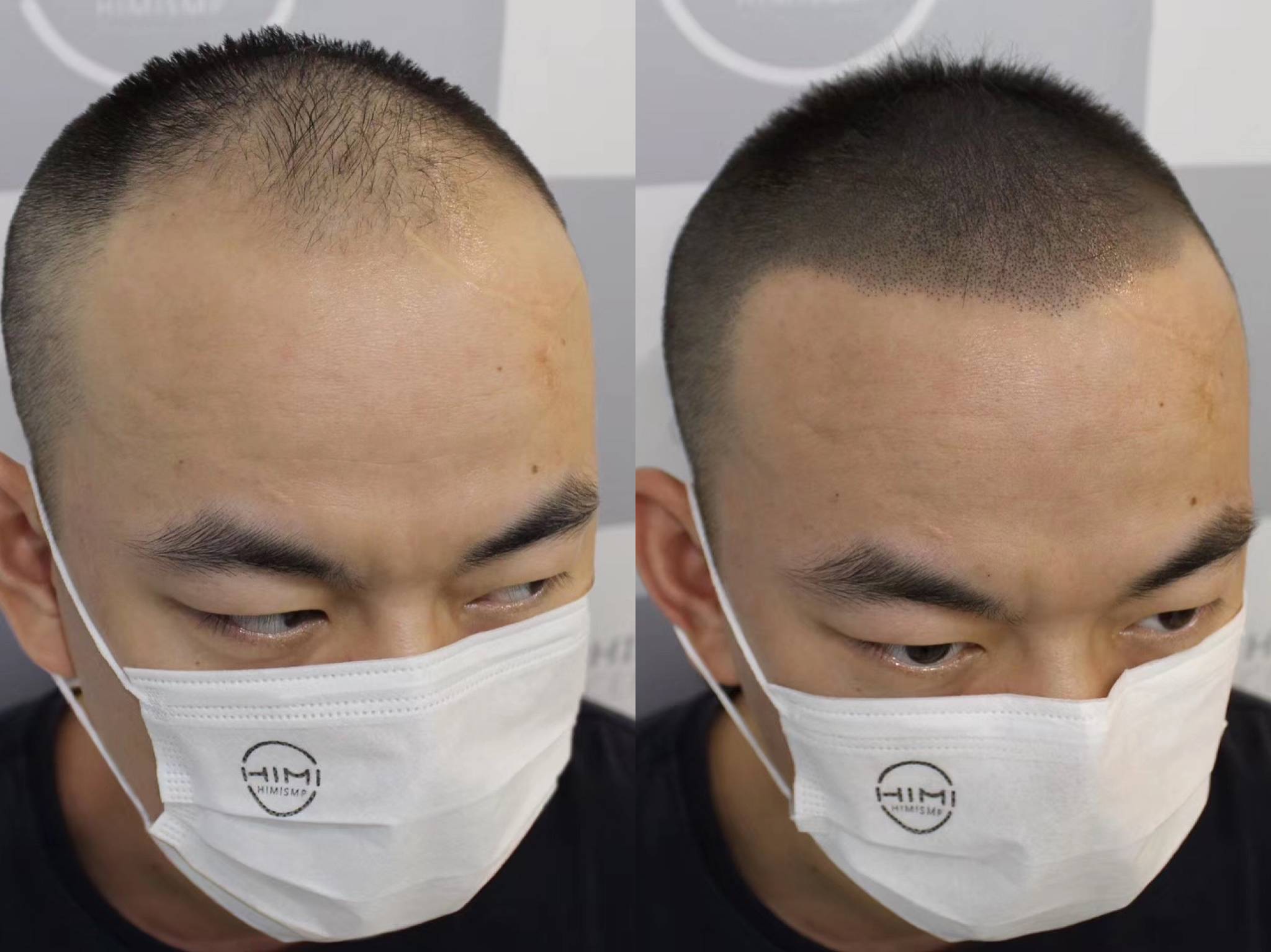 拯救脱发计划,秃顶还是有办法解决的!