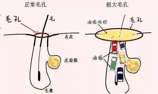 毛孔粗大的后果不仅是变丑这么简单!