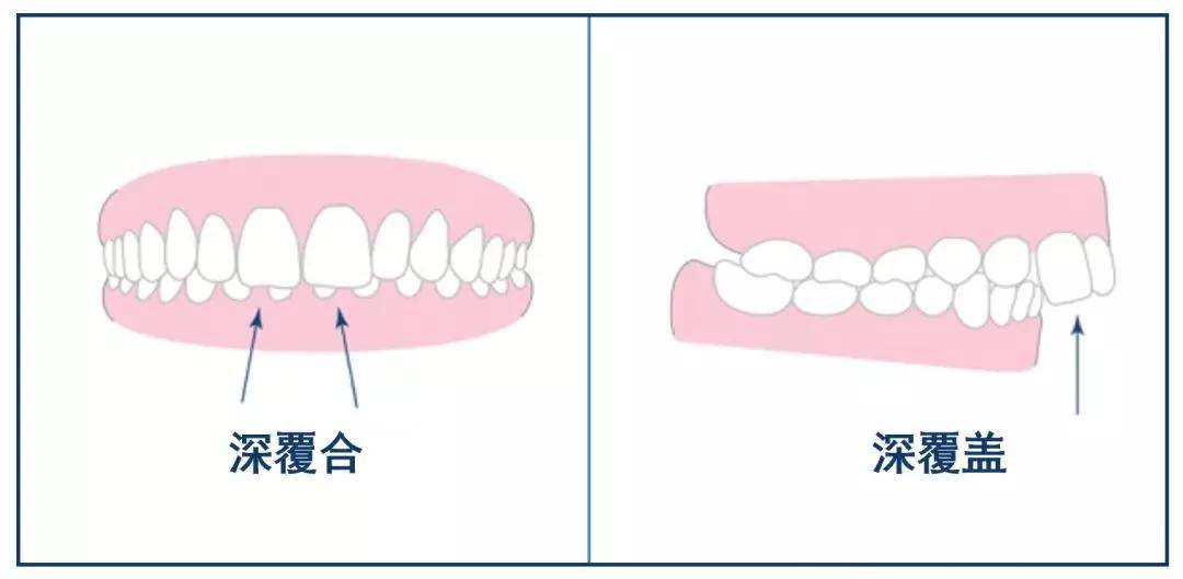 【淄博】深覆盖 vs 深覆合如何区分?这一篇看完就都了