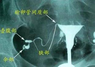 什么时候检查输卵管通畅 198f27788e894104bb3ae3911e97bd41.jpeg