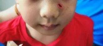 3岁男童左脸被鸡抓伤，竟原地“长出”鸡趾甲？家长做的蠢事