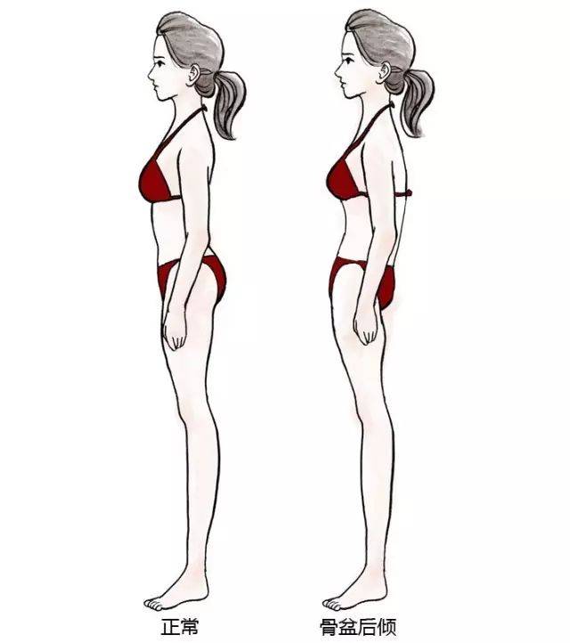 有前倾就会有后倾,骨盆后倾通常表现为站着时 习惯性把胯往前送.