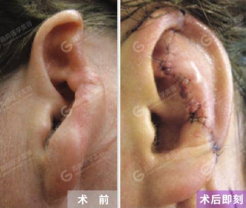 孩子小耳畸形，做耳再造手术痛苦大吗？