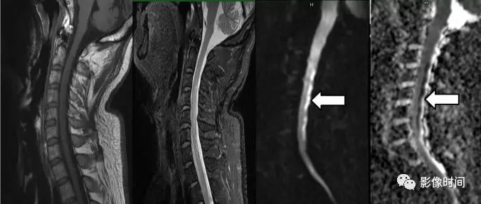 17种脊髓病变影像解读你get了吗