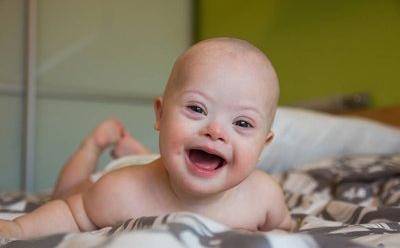 宝宝有特殊的外貌是唐氏综合症的表现吗?儿科医生告诉您!