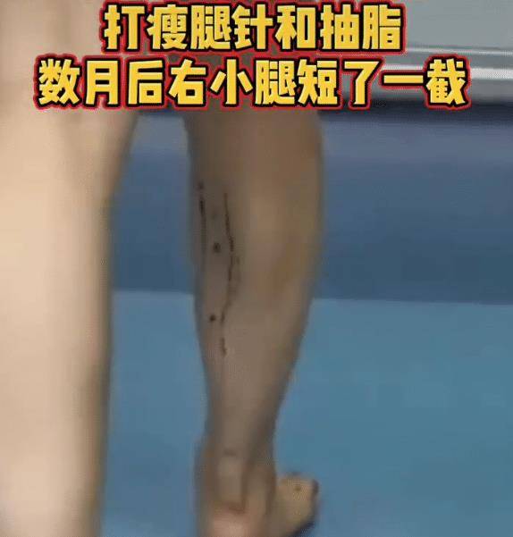 女子花万元打瘦腿针小腿短了一截走路姿势太可怕