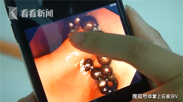 爸妈|怕爸妈责备竟说只吃了1颗！3岁娃误吞19颗磁力珠
