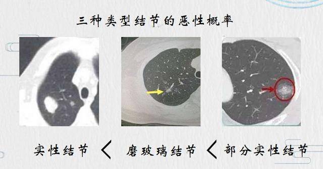 原创45岁刘女士查出6mm肺结节,疑似肺癌,用这个方法结节缩小4mm