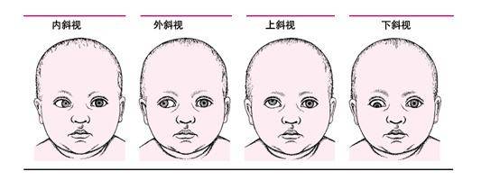 儿童斜视该怎么办?赶快先按这方法自查一下