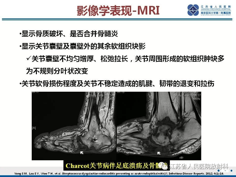 肘夏科氏关节病