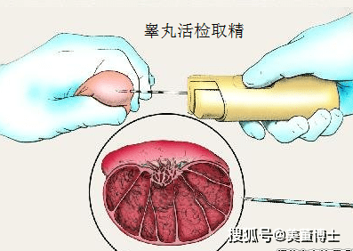 上海同济医院纪亚忠医生:成就"爸业"的"取精"路上,要注意这些!_睾丸