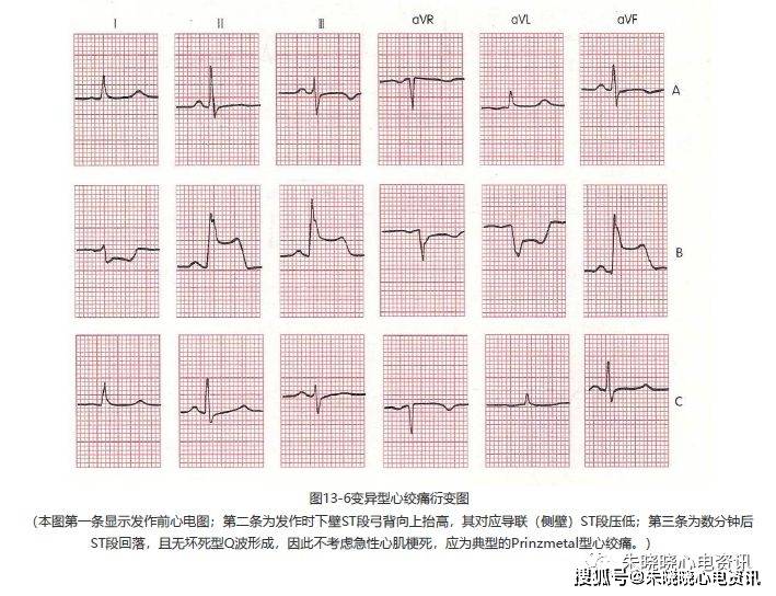 第十三讲:st段改变与心肌缺血1_心电图