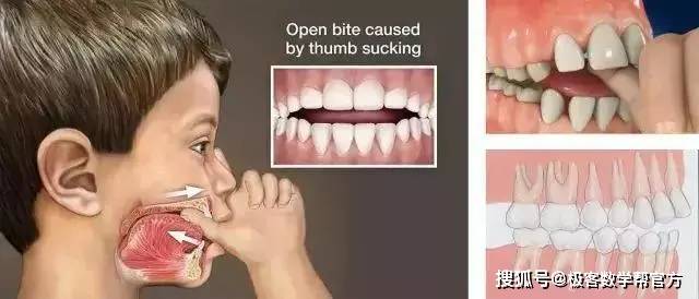 牙齿|家长请注意：孩子12岁前必须矫治的几种牙齿畸形
