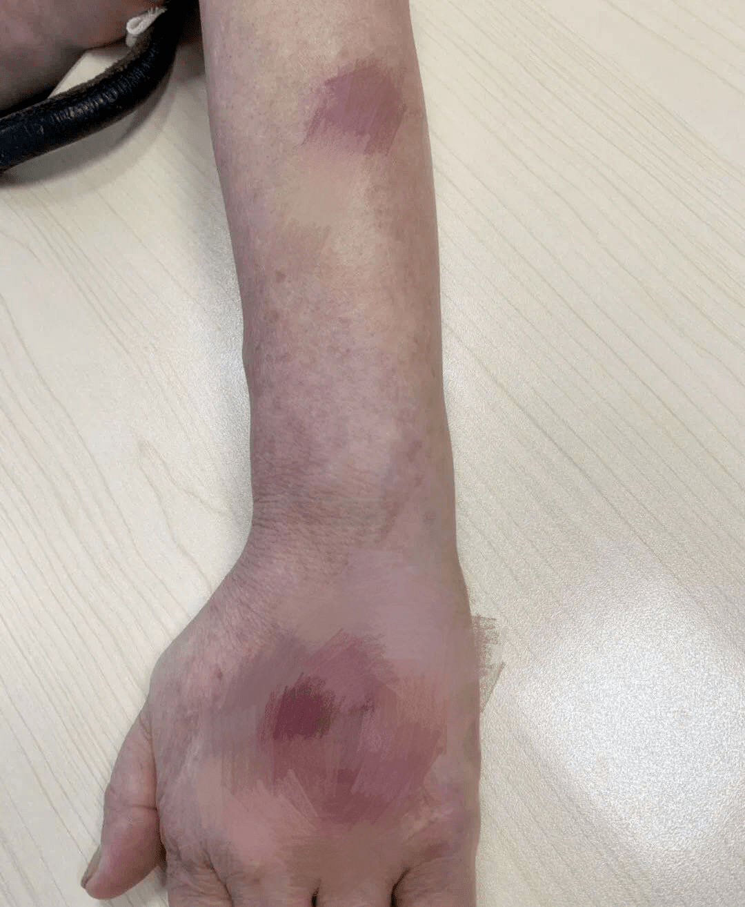 手指被鱼鳍刺了一下,感染海鱼分枝杆菌,后来开始溃烂