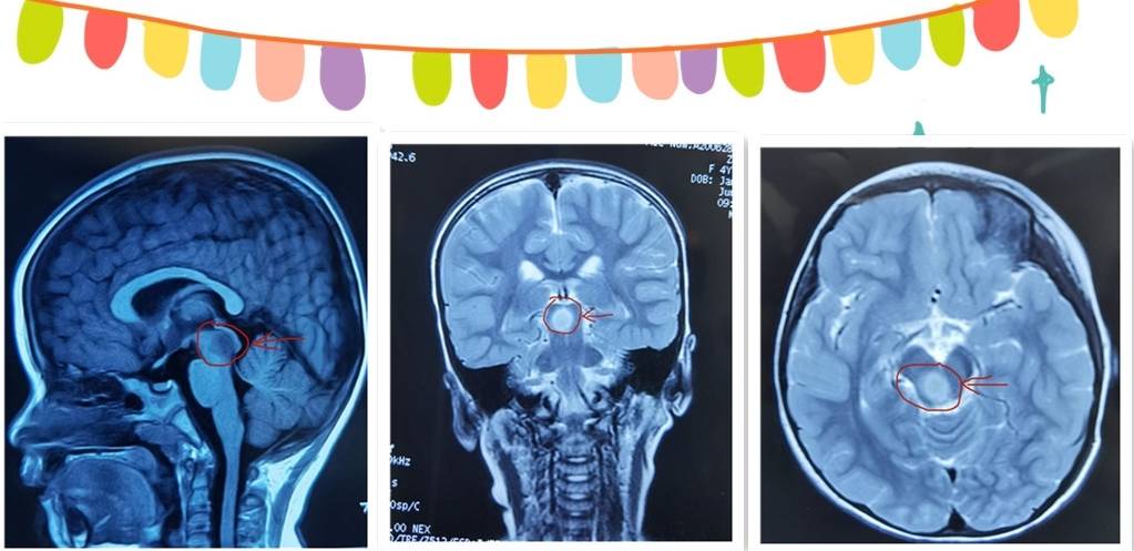 原创儿童脑干肿瘤——中脑肿瘤手术全切除