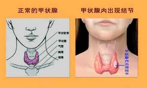 甲状腺实质主要由许多甲状腺滤泡组成