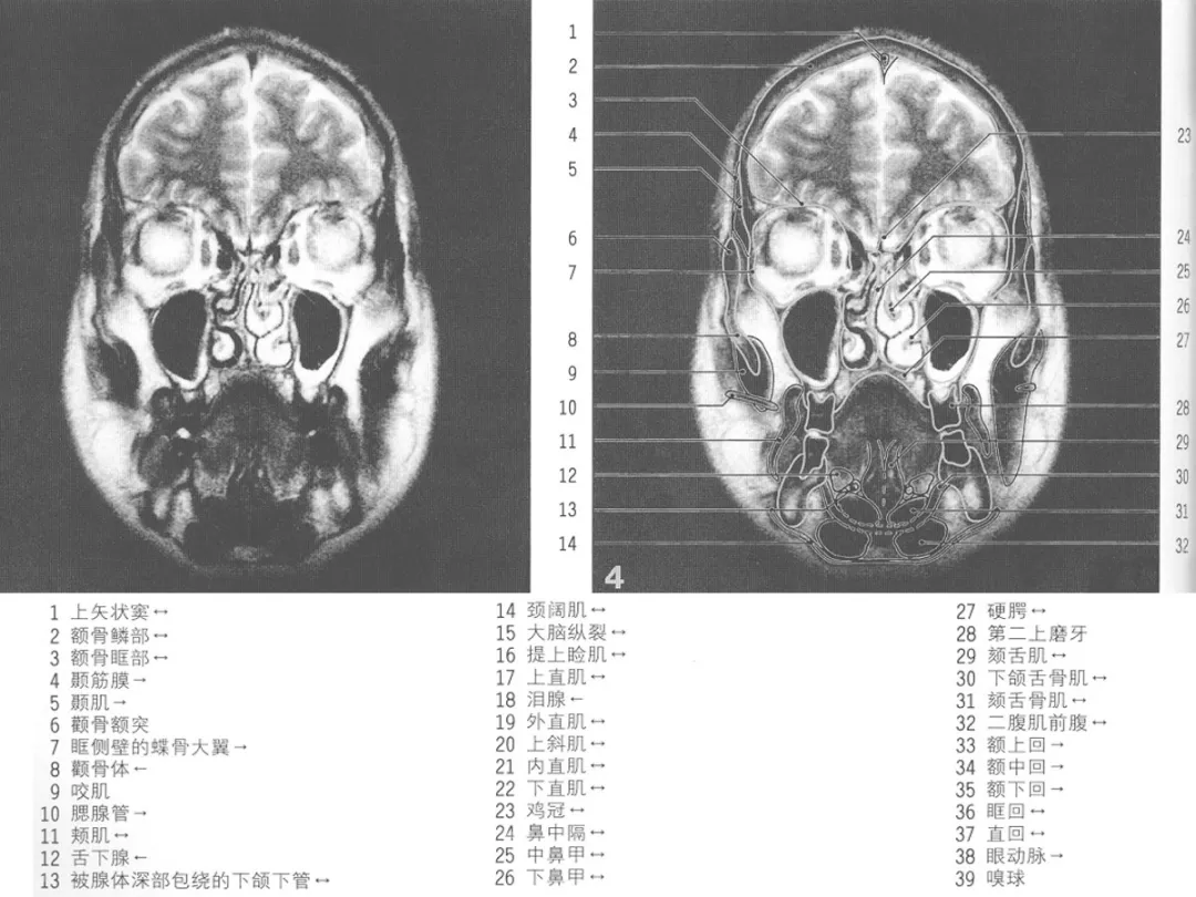 影像基础mri颅脑冠状位解剖图谱