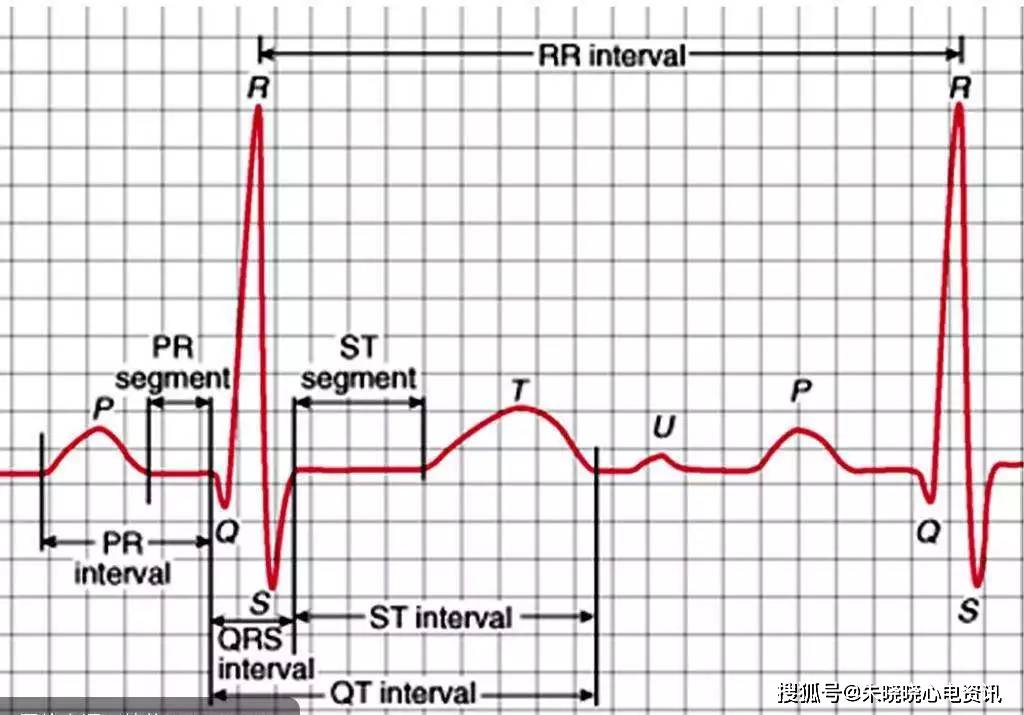 掌握这6项心电图干货,波形判断不再难!