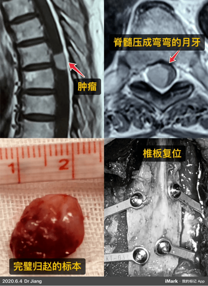 医者解读警惕不一样的腰腿痛椎管内常见肿瘤