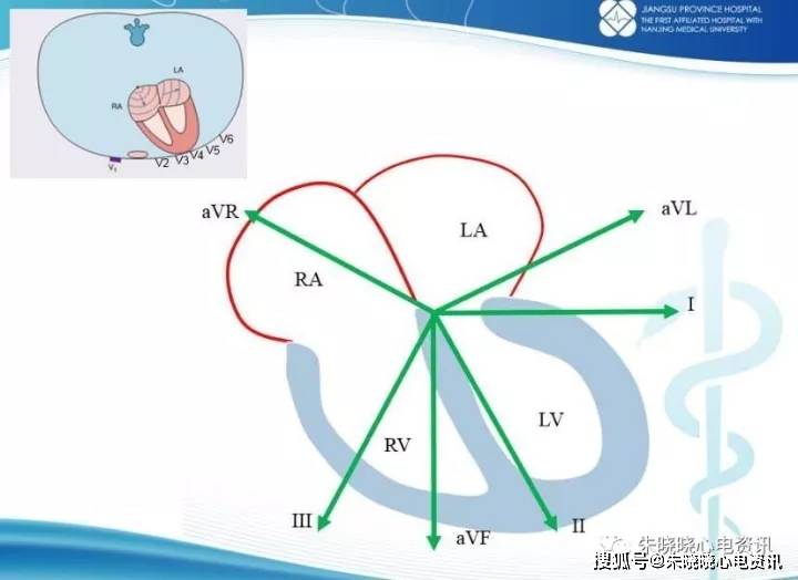 心电图定位心肌梗死相关血管
