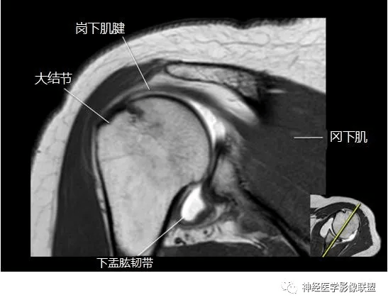 肩关节磁共振断层解剖