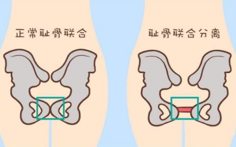间,并有利于分娩时胎儿通过骨盆,因此耻骨联合分离